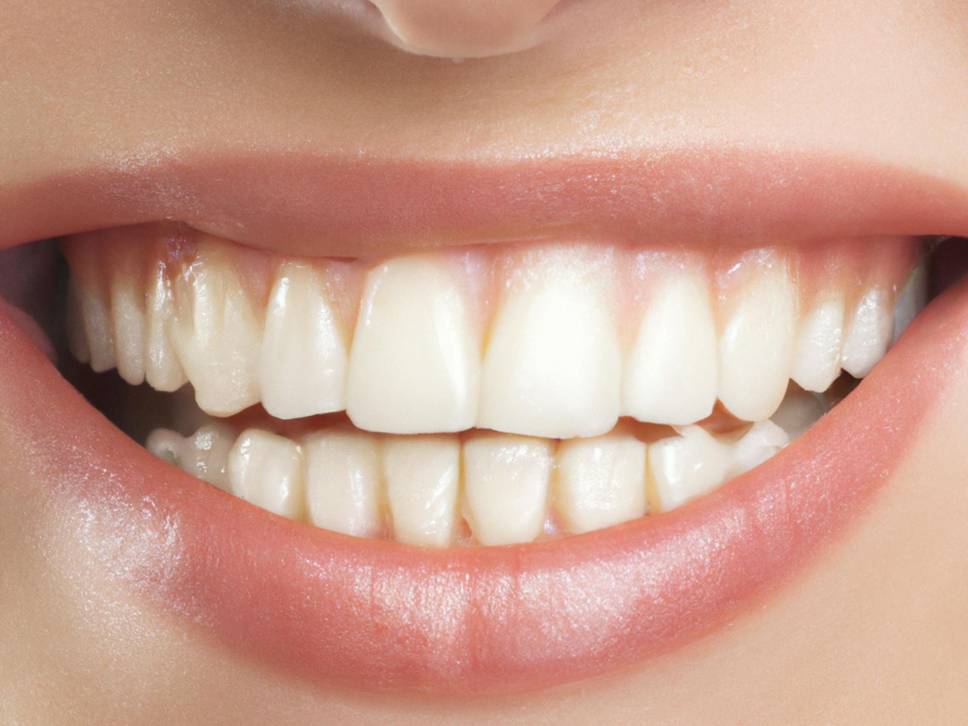 Veneers